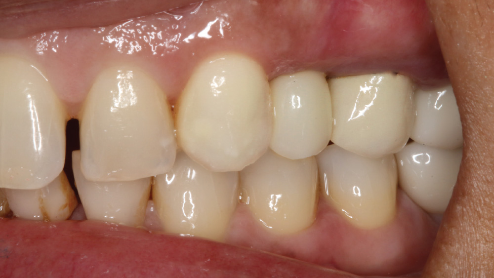 Final close-up of patient's implant restorations