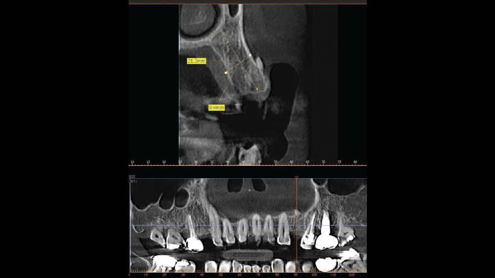CBCT analysis that visualizes vital anatomy and bone contours