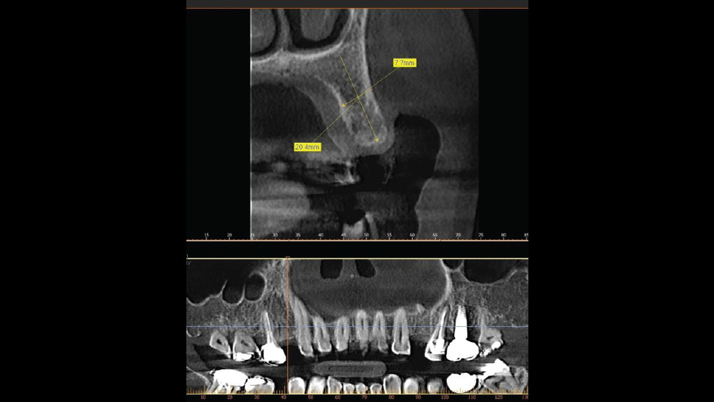 CBCT analysis that visualizes vital anatomy and bone contours