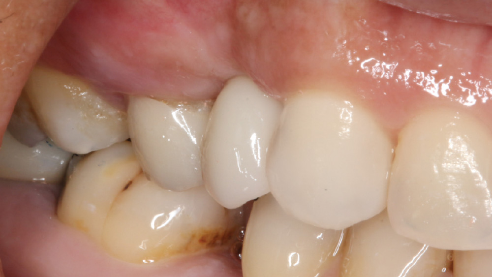 Close-up of area of restorations