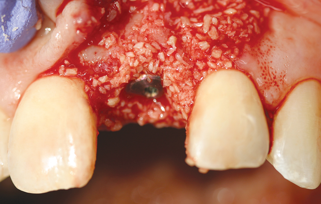 Bone Grafting Image 2 CSM V15I2-