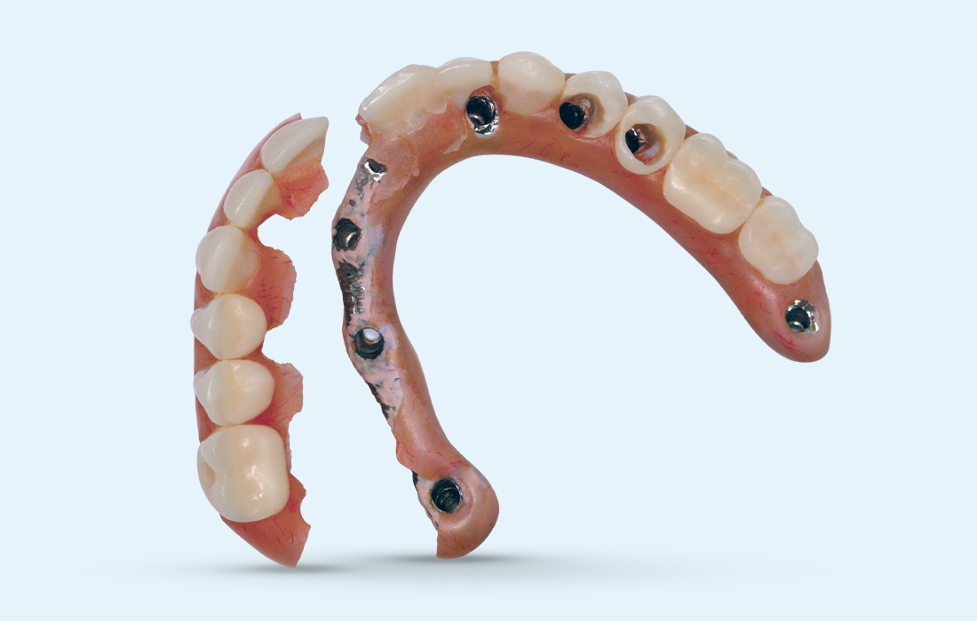 BruxZir Implant Prosthesis Image 1 CSM V15I2