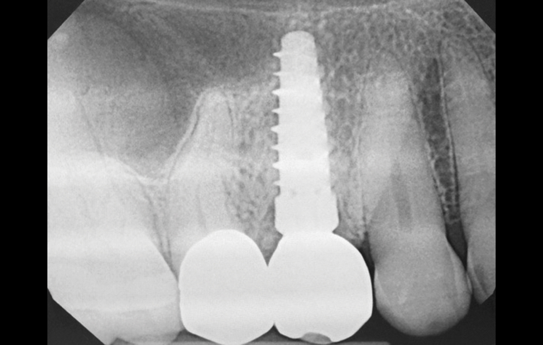 Steri-Oss Implant CSM Image 1 V15I2
