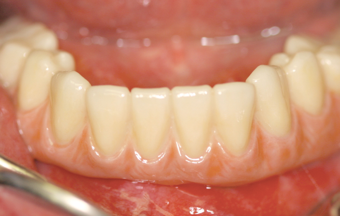 Hahn Clinical Case Image 3 CSM V15I2