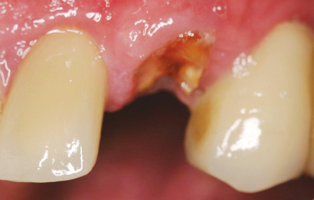 Hahn Clinical Case Image 4 CSM V15I2
