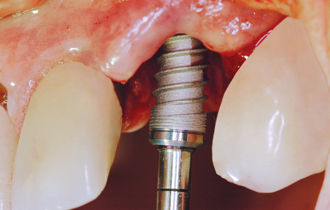 Hahn Clinical Case Image 5 CSM V15I2