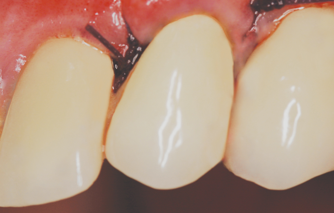 Hahn Clinical Case Image 6 CSM V15I2