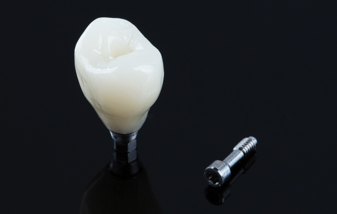 Screw-retained BioTemps provisional