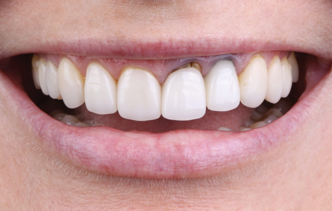 Teeth #9 & #10 were non-restorable due to vertical root fractures.