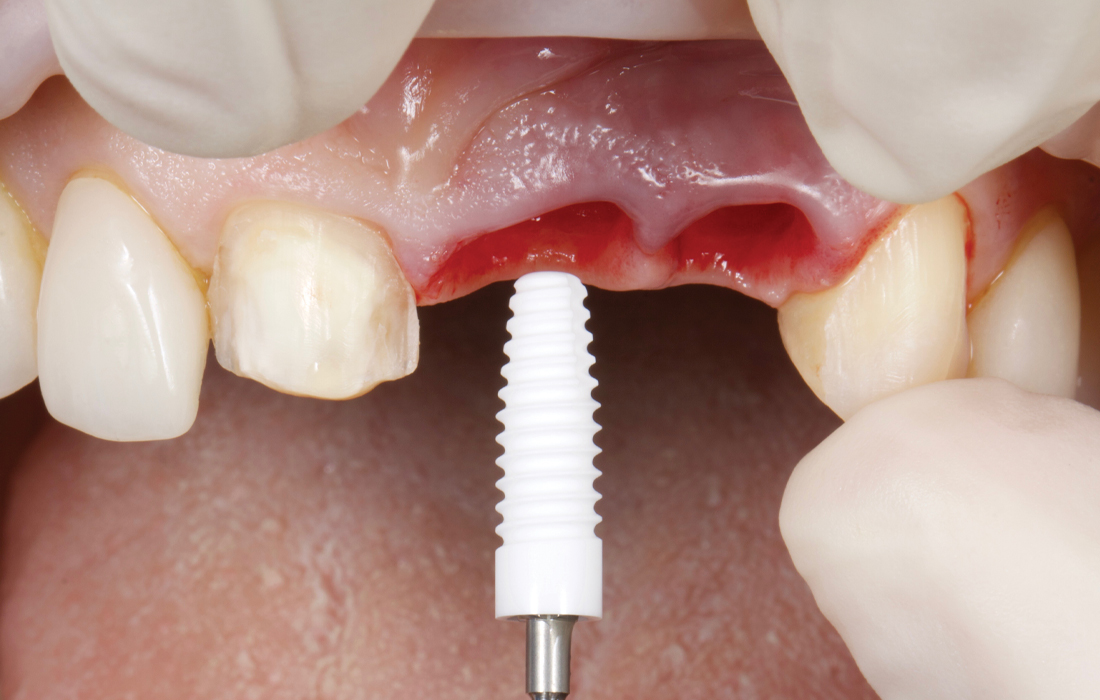 ZERAMEX® XT Implant
