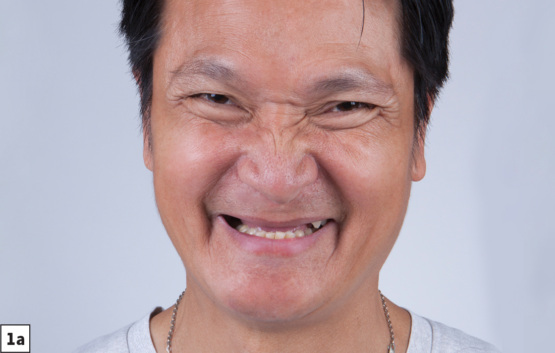 Patient was edentulous in the area of teeth #4–12