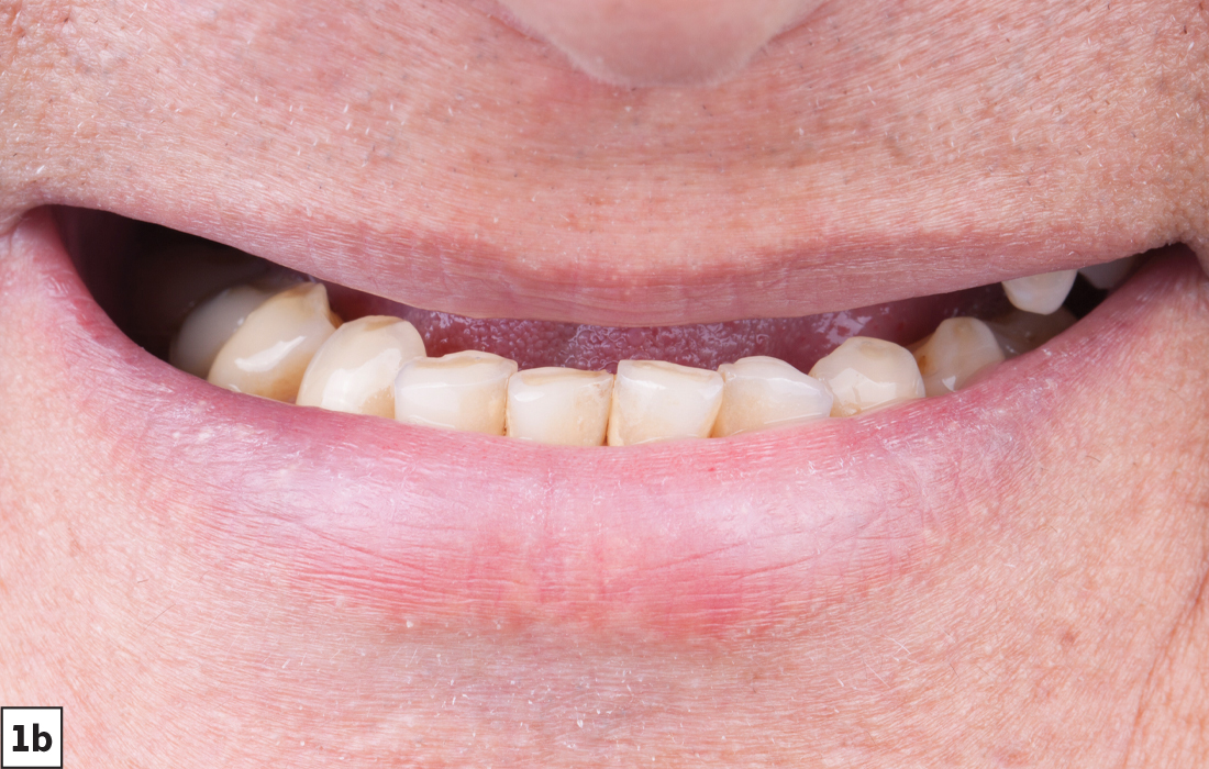 Patient had a collapsed vertical dimension