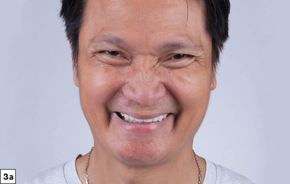 The Smile Transitions cosmetic appliance