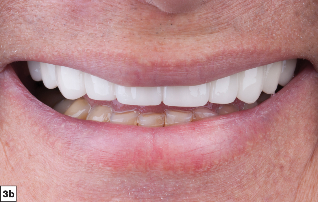 Smile Transitions appliance.