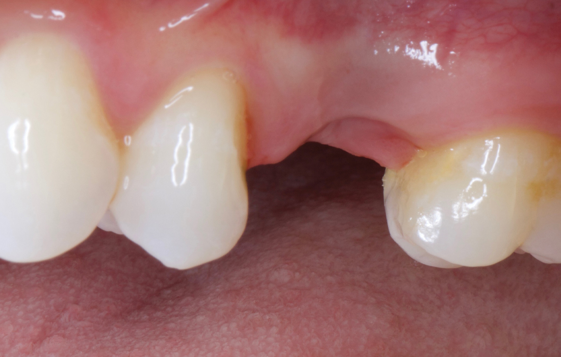 A failing implant at site #13