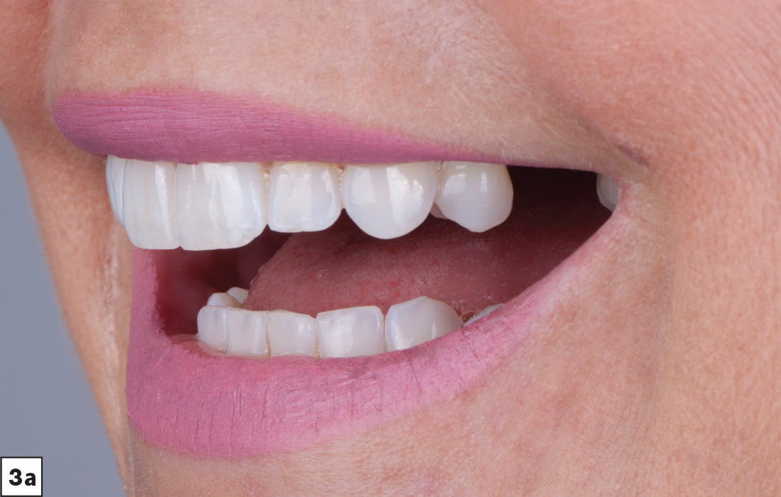 Patient smile with missing tooth