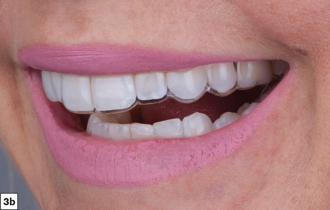 Essix retainer in patient mouth