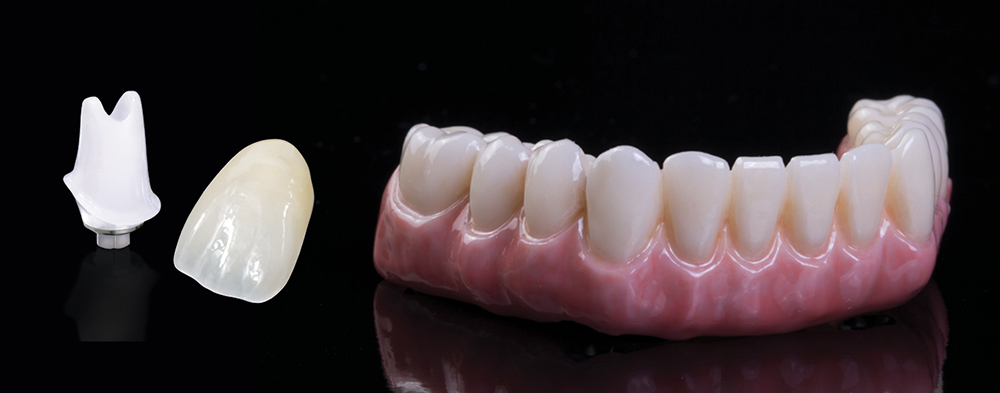 BruxZir® Implant Prosthesis