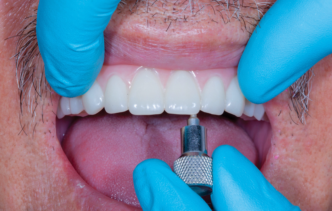 Provisional implant prosthesis given to patient