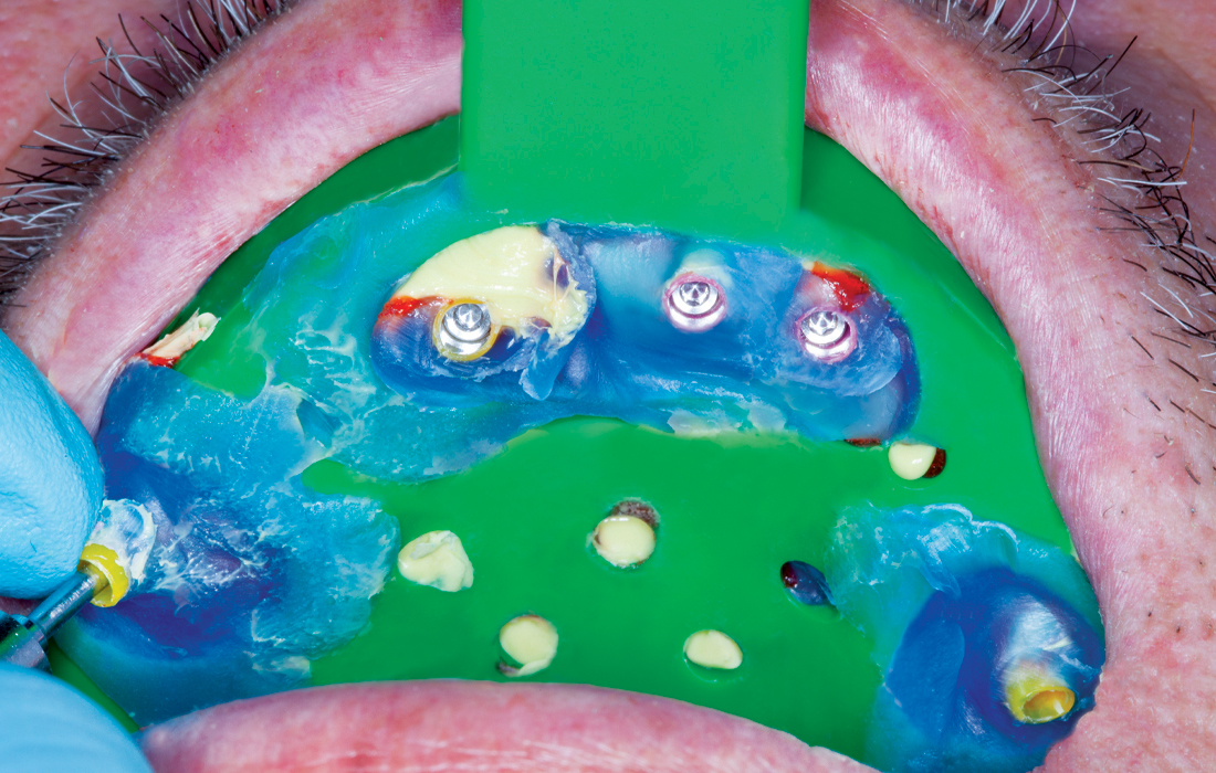 Preliminary impression was taken