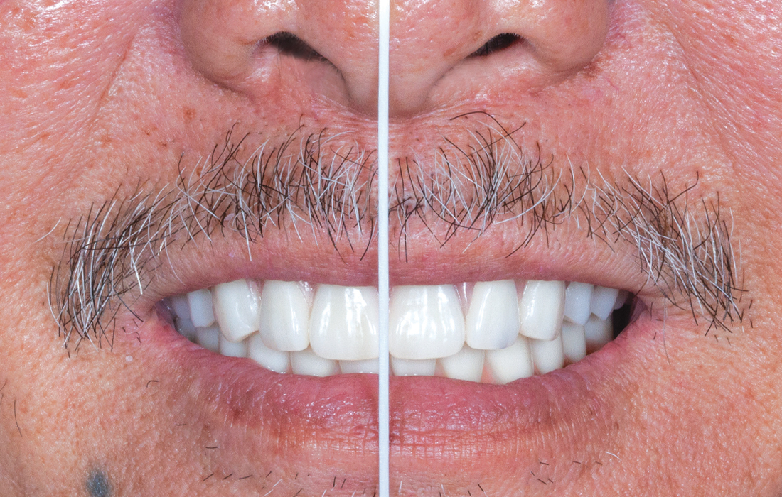 Before and after try in wax setup