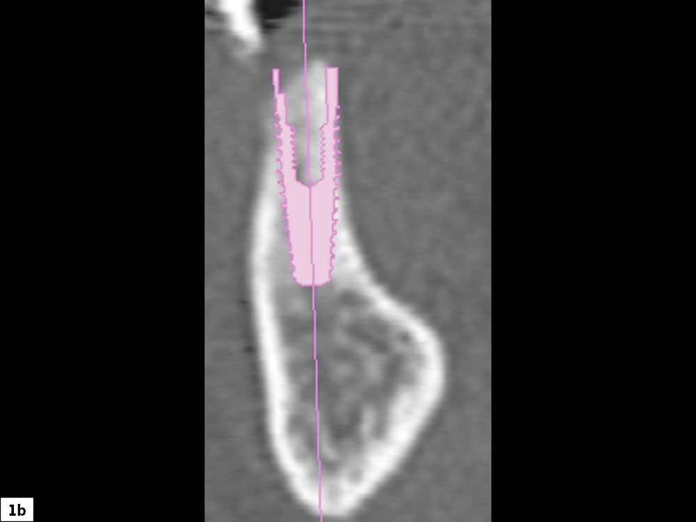 Compromised bony ridge width