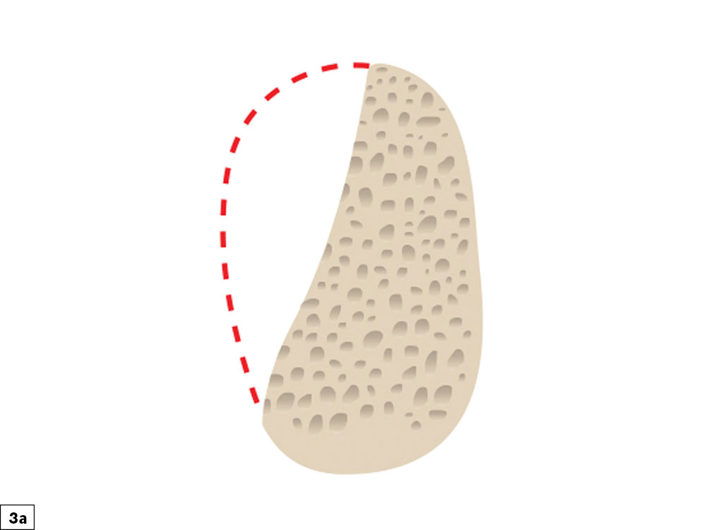 Straight/convex bony defect illustration