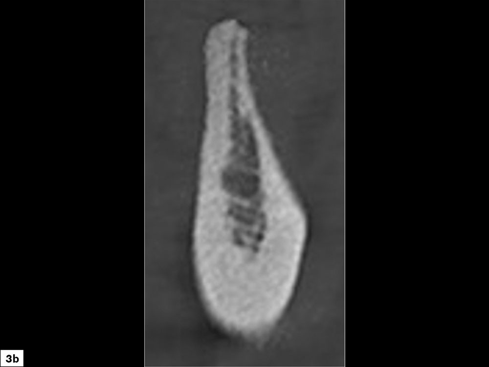 Width-compromised bony ridges