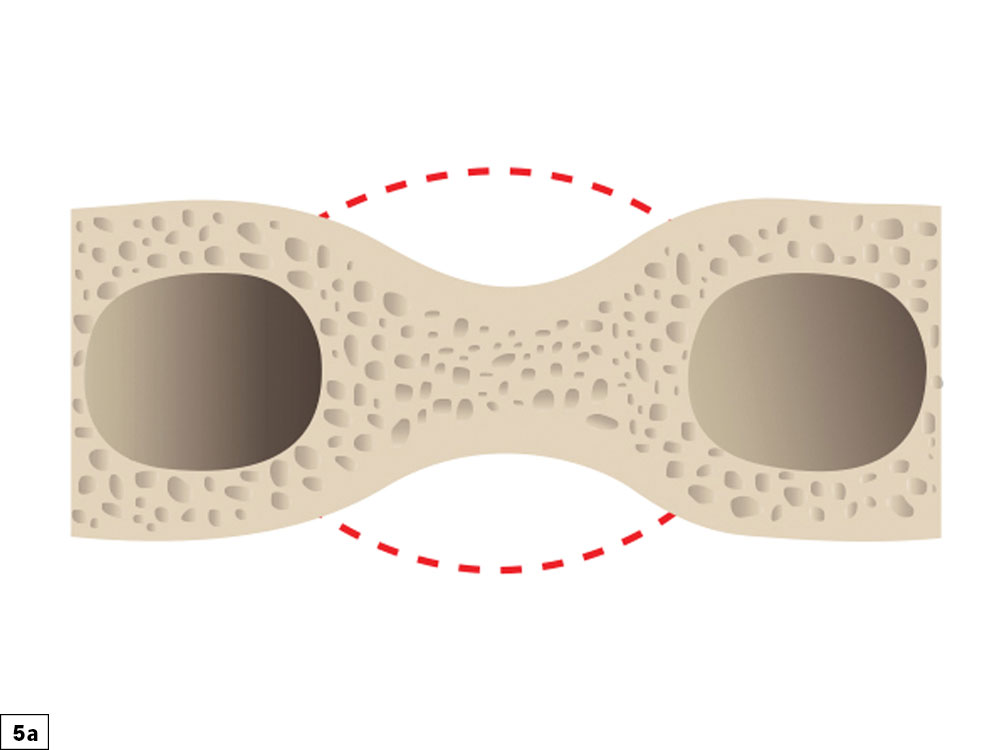 Buccal-lingual bony defect illuatration: An hourglass type of ridge morphology