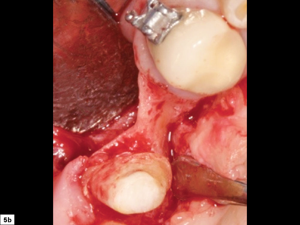 Close-up of space maintenance and prevention of micromovement of the graft material