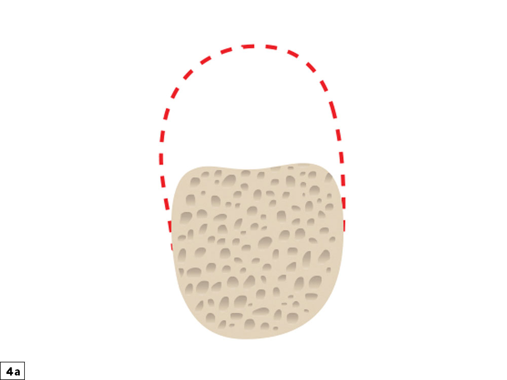 Vertical height bone defect illustration