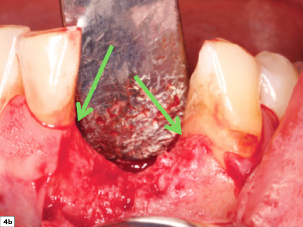 Vertical height bone defects