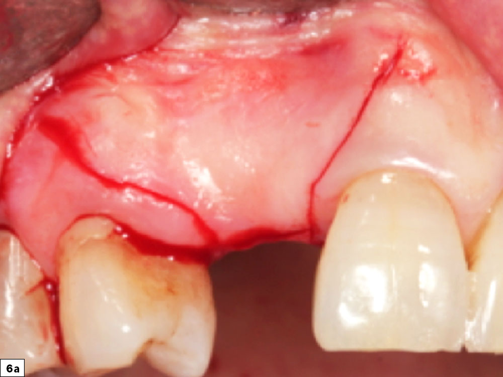 Papillae-sparing incision maintains blood supply