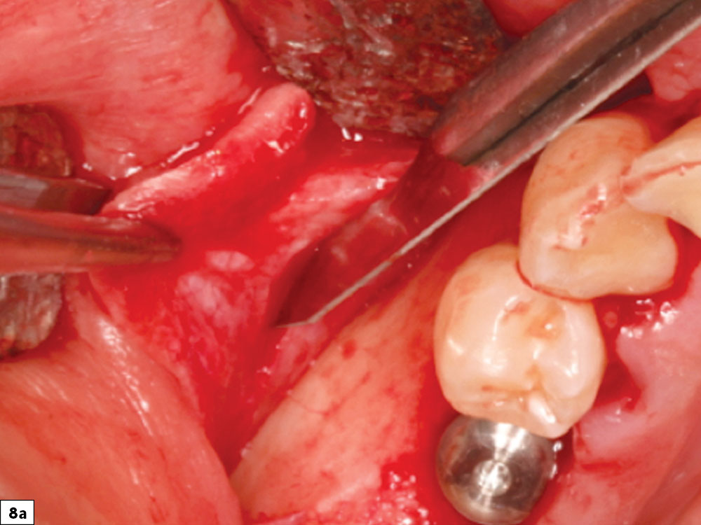 Periosteal release incisions with a No. 15 blade