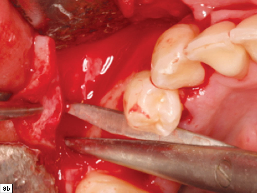 Broadbased tissue release with Metzenbaum scissors