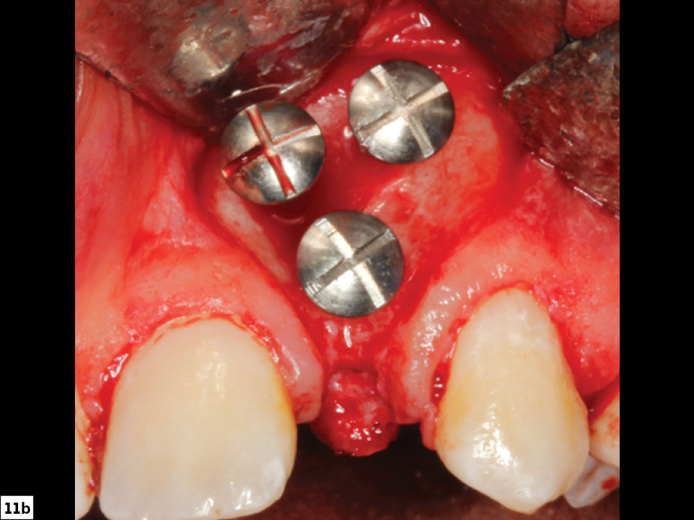 Tenting screw positioning on site