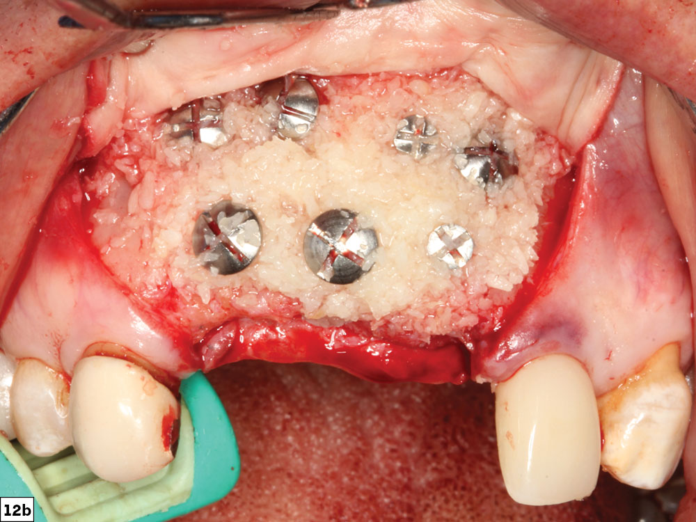 Material of the cortico/allograft is added using bone-packing instrument