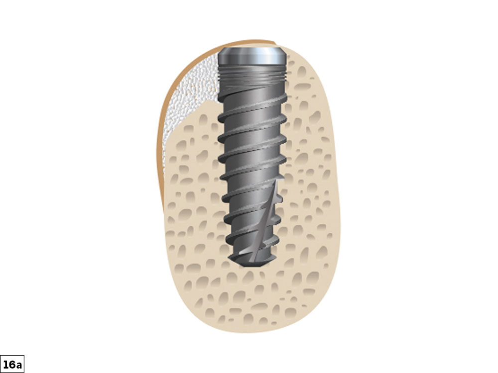 small depression defect illustration