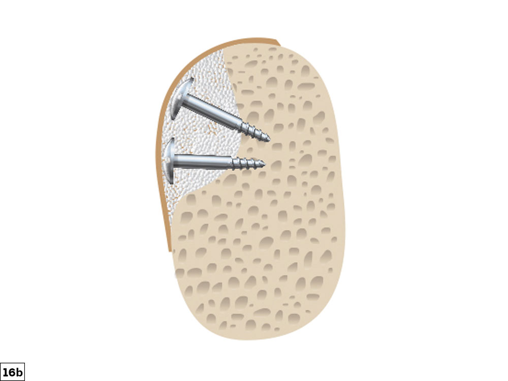 concavity defect illustration