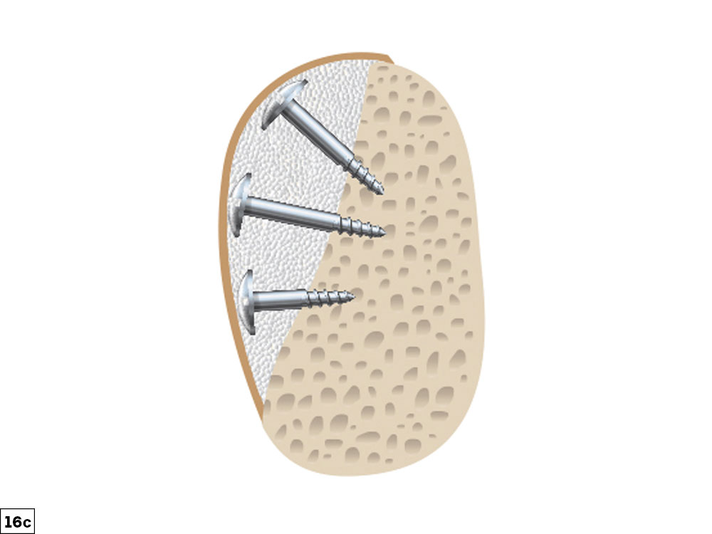 straight/convex defect illustration