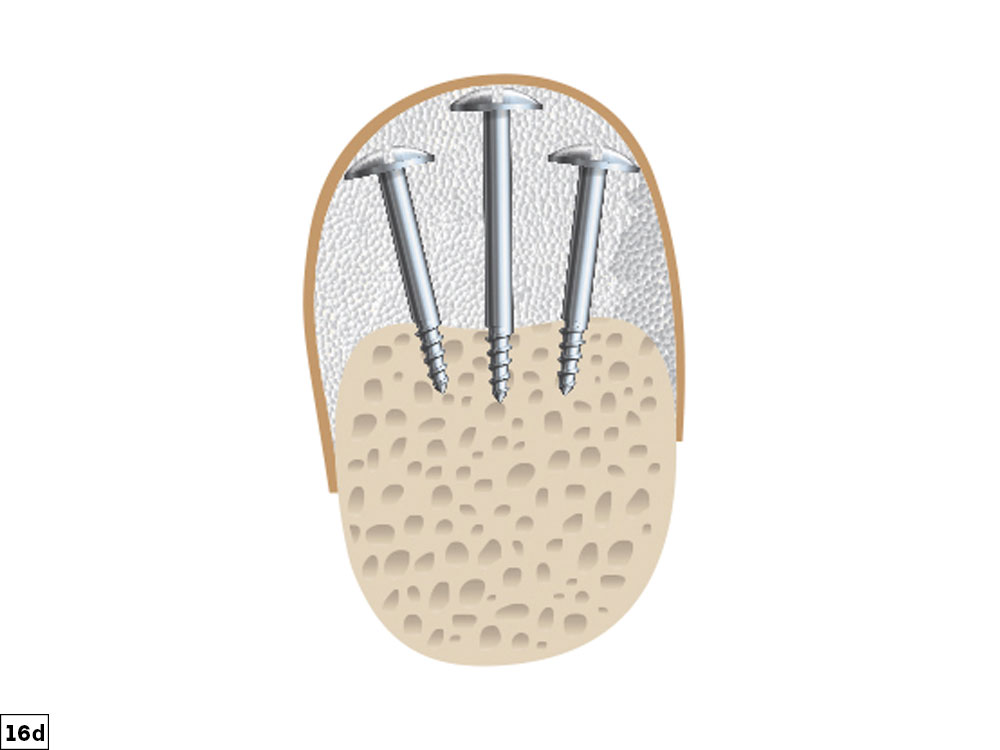 vertical defect illustration