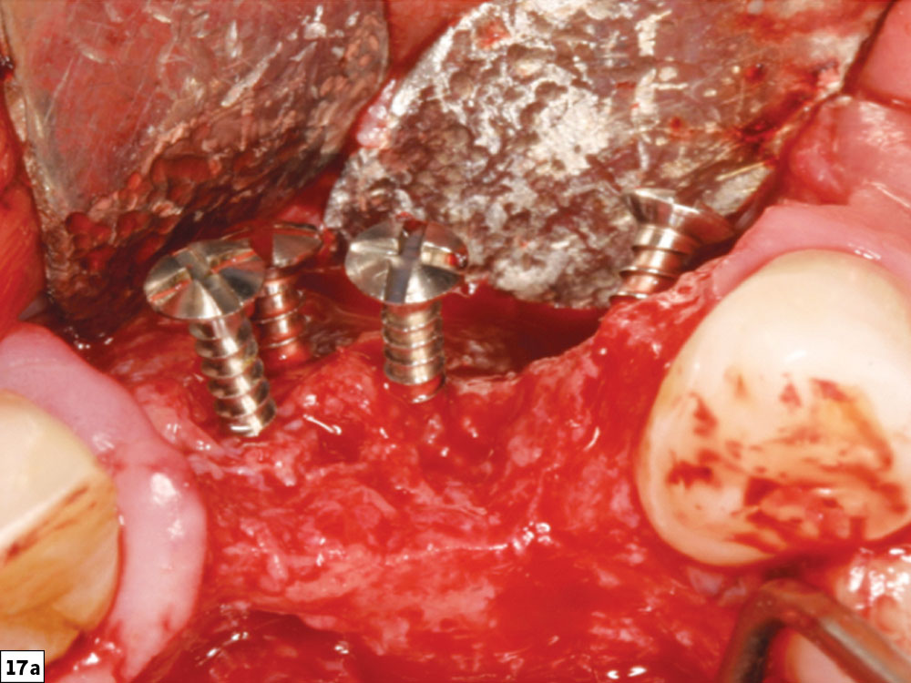 Concavity-type defect
