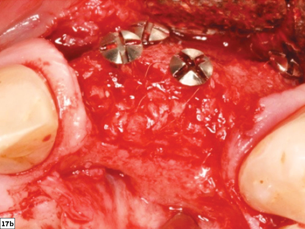 post-healing image depicting bone growth to the level of the tenting screws