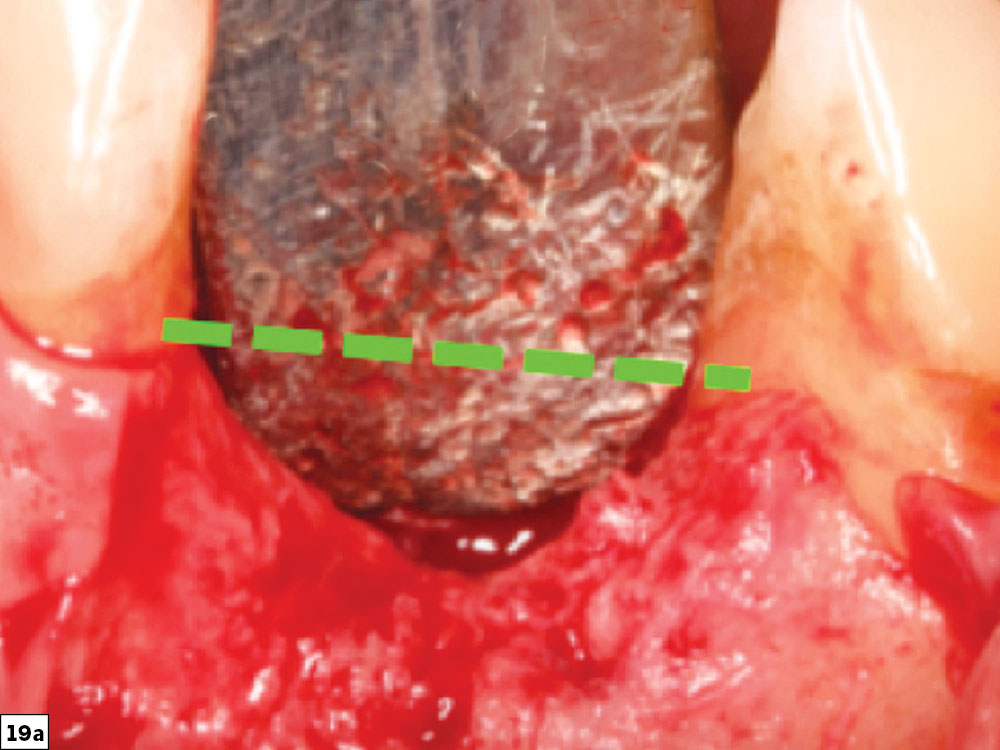 Vertical defect close-up