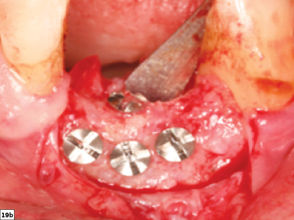 Horizontal and vertical bone growth to the level of adjacent teeth