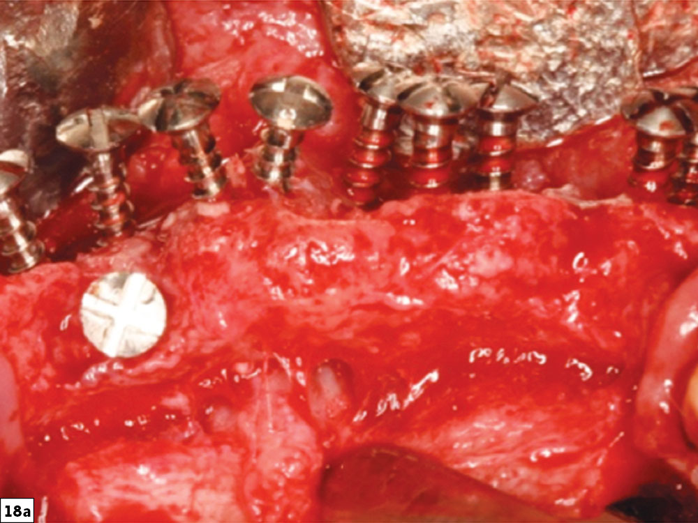 Straight/convex-type bone defect