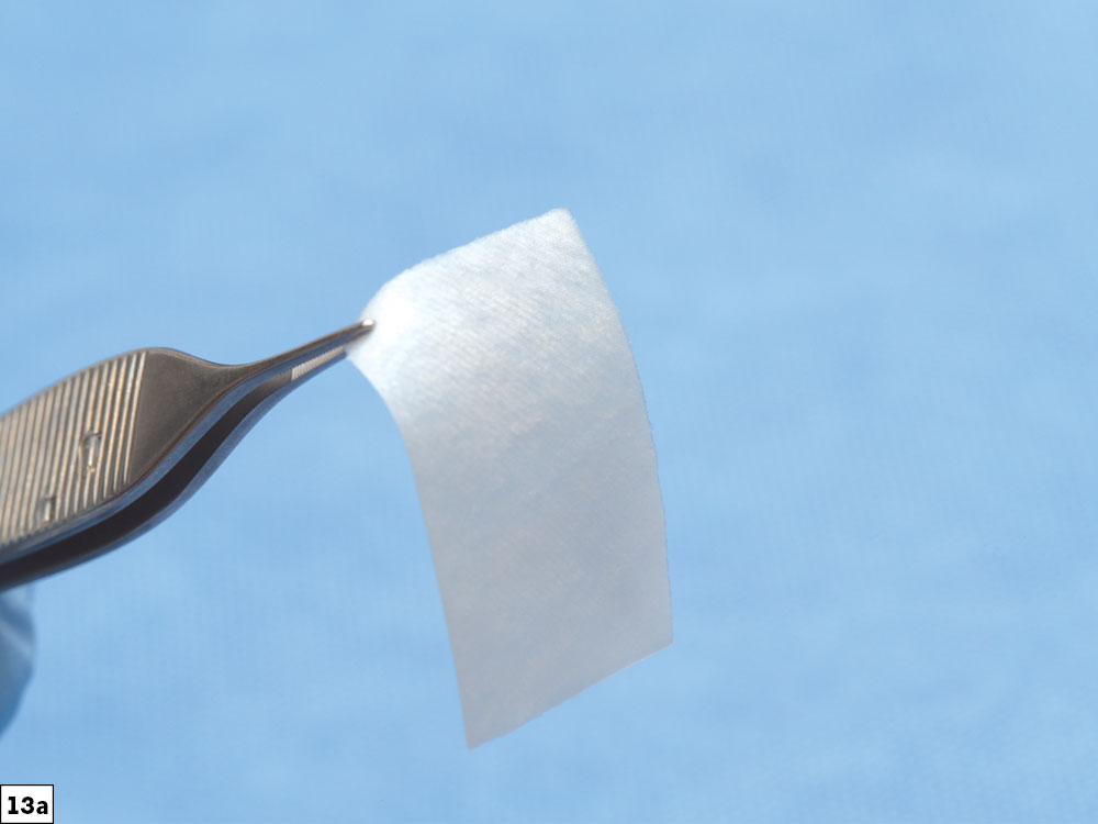 Guided Bone Regeneration: 8 Steps to Successful Ridge Augmentation Fig. 13a CSM v15I2