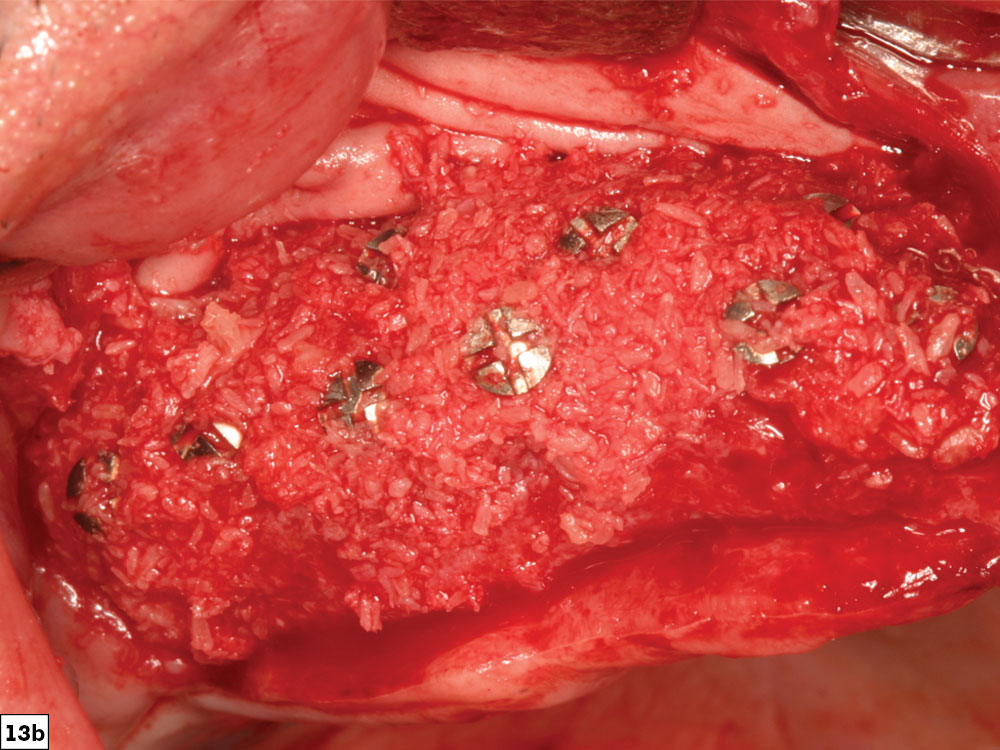 Guided Bone Regeneration: 8 Steps to Successful Ridge Augmentation Fig. 13b CSM v15I2