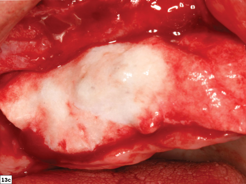 Guided Bone Regeneration: 8 Steps to Successful Ridge Augmentation Fig. 13c CSM v15I2