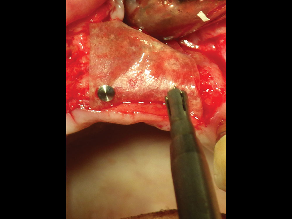 membrane can be fixated on one side apically or lingually prior to bone graft placement